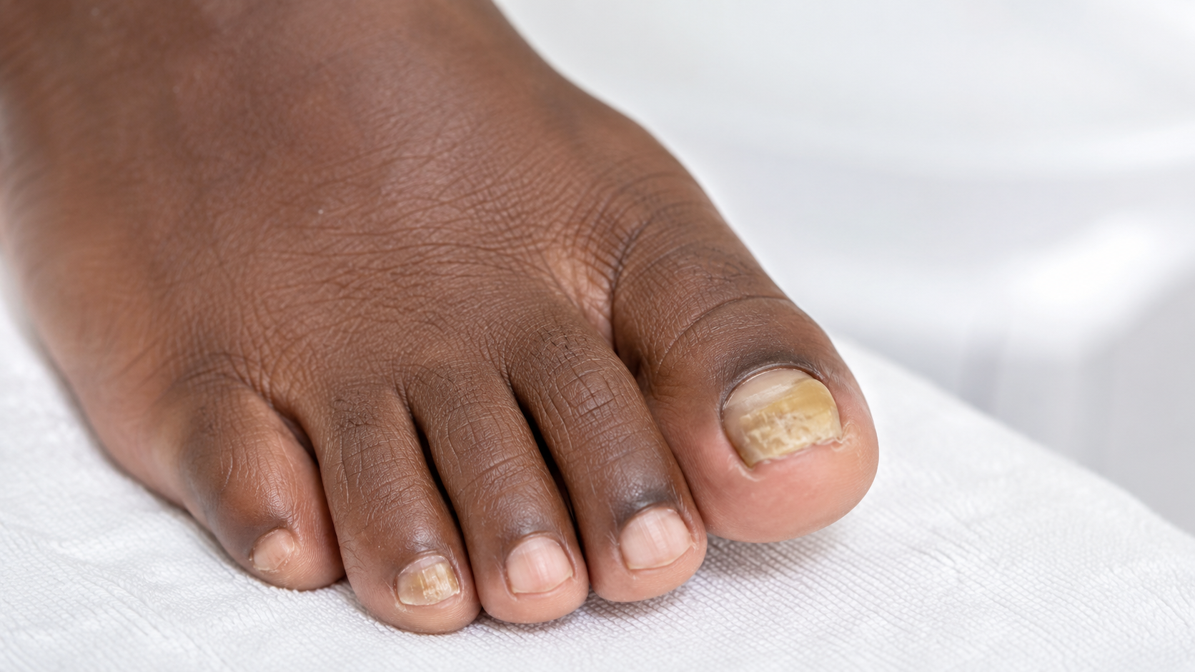 Nail fungus affecting toenails
